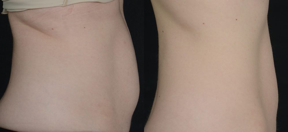 Before / After