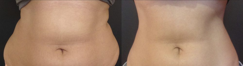 Before / After