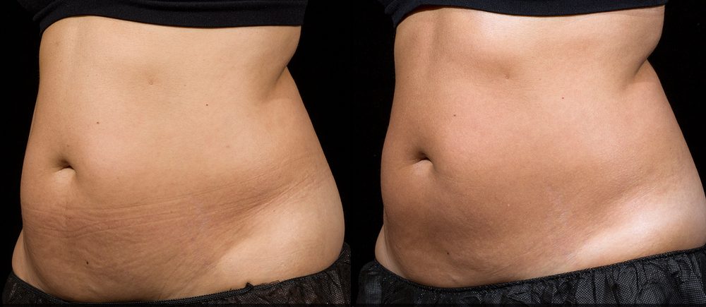 Before / After